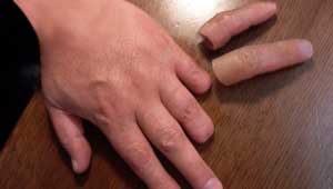 कटी उंगली