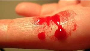 रक्तस्राव