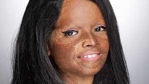 लक्ष्मी अग्रवाल-तेजाब पीड़िता